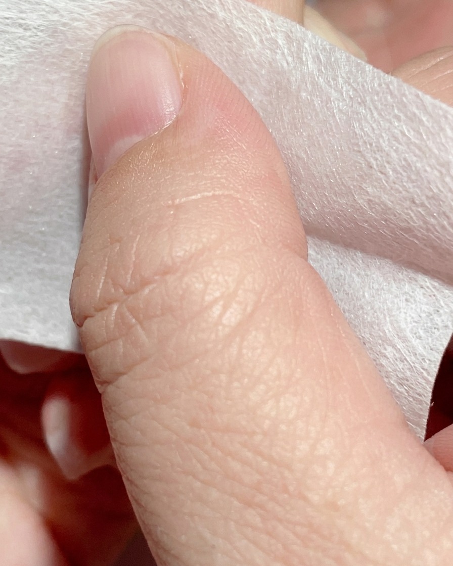 Un pad per unghie imbevuto di liquido detergente che pulisce la superficie dellunghia.